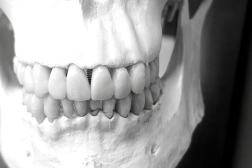 Dental Bone Grafting