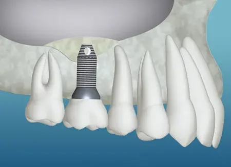 Bone Grafting for Dental Implants