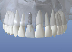 Dental Implant Procedure
