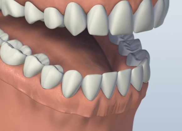 Implant supported overdenture