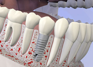 Dental Implants
