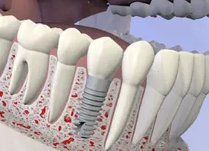 Dental Implants