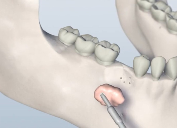 Third Coast Bone Grafting
