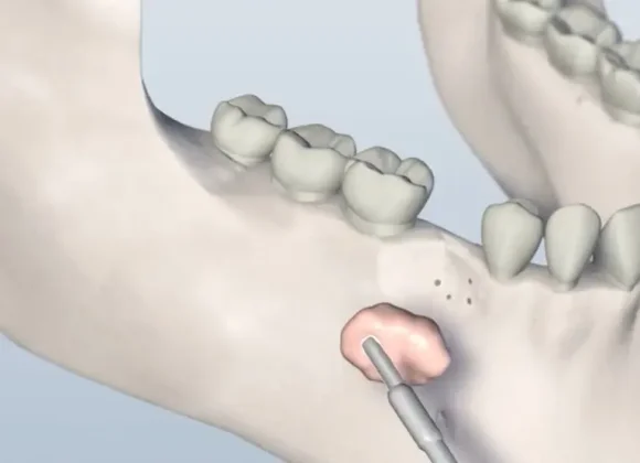 Third Coast Bone Grafting