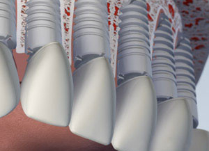 Upper Teeth Dental Implants