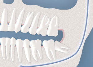 Impacted Wisdom Teeth