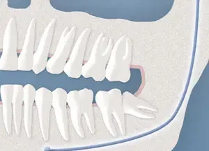 Impacted Wisdom Teeth