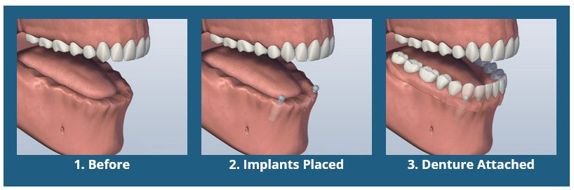 Ball Attachment Denture