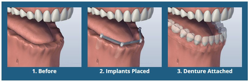 Bar Attachment Denture
