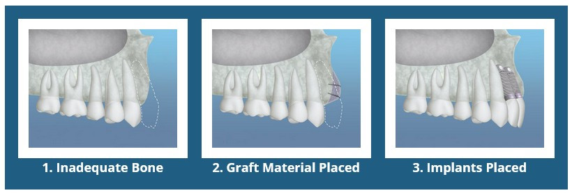 Bone Grafting for Dental Implants