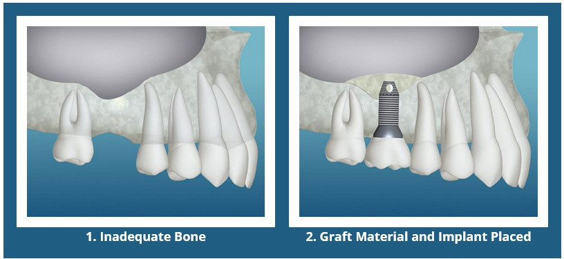 Bone Grafting for Dental Implants