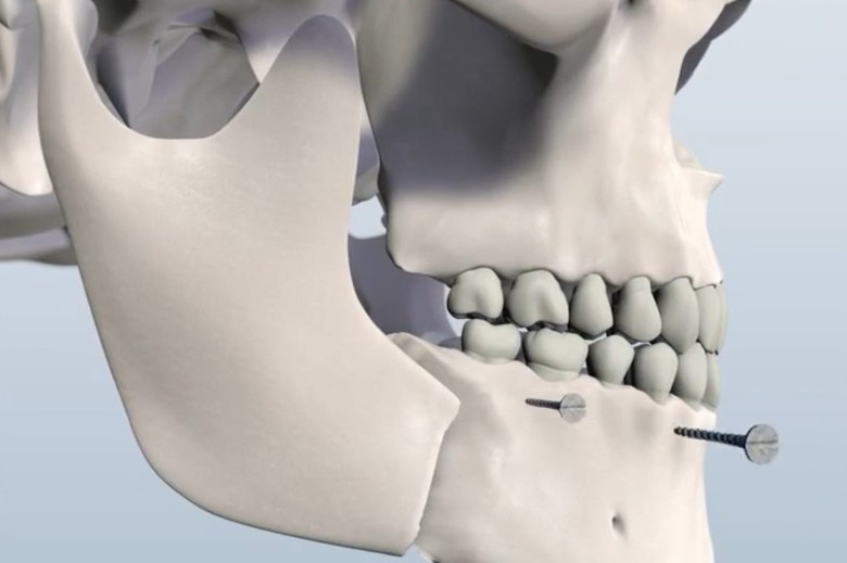 Corrective Jaw Surgery