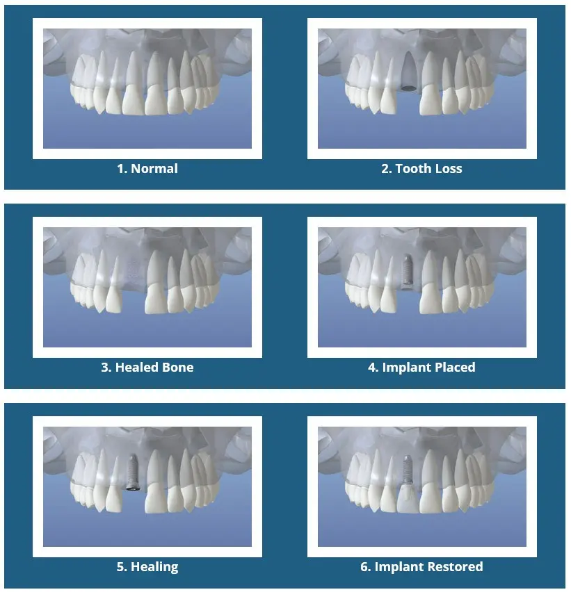 Dental Implant Overview