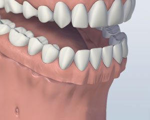 Dental Implant Denture