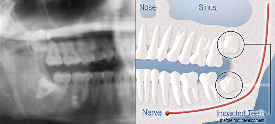 Wisdom Teeth Impaction