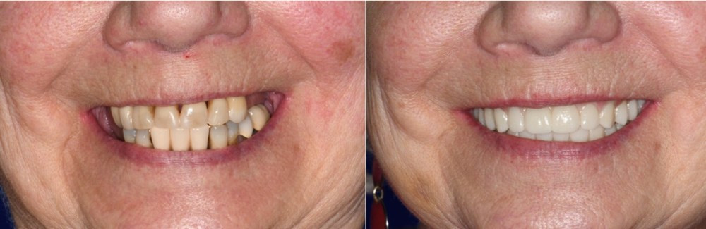 Full Arch Replacement