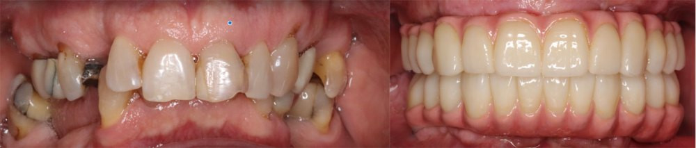 Full Arch Replacement