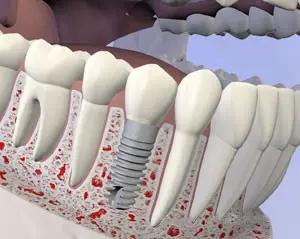 Dental Implant