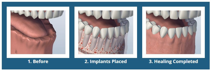 Individual Implants