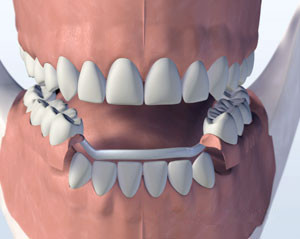 Dental Implant Metal Partial
