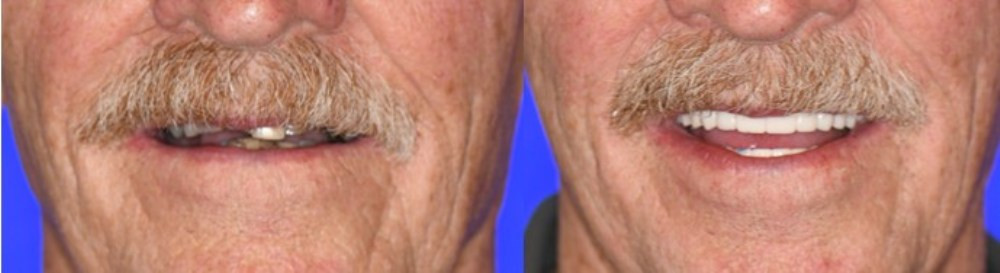 Full Arch Replacement