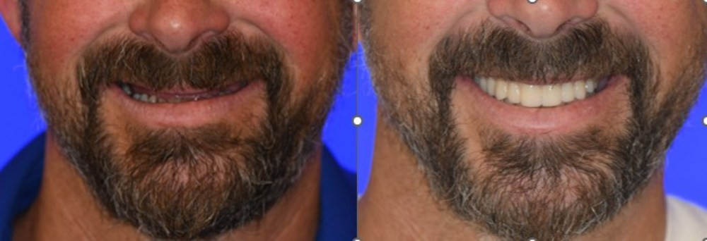 Full Arch Replacement