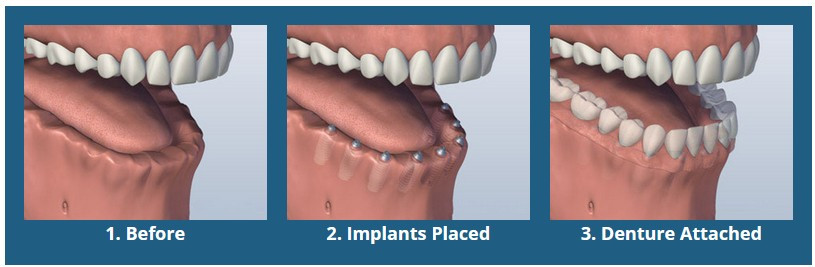 Screw Retained Denture