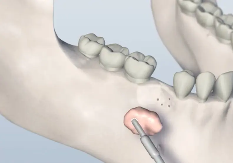 Third Coast Bone Grafting