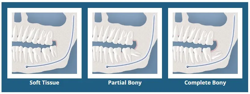 Types of Impaction
