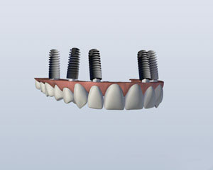 Implant Retained Upper Denture