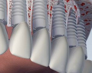 Individual Upper Implants